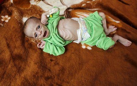 Ali Mohammed al-Tawaari, a six-month-old malnourished boy, lies in a bed at a hospital in Sanaa, Yemen, July 28, 2015. PHOTO BY REUTERS/Khaled Abdullah