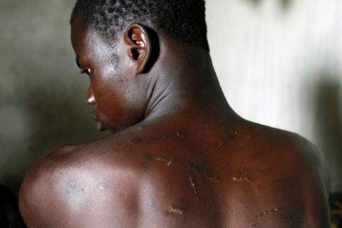 Zongo Meda, a 21-year-old cocoa farmer, shows his wounded back after being beaten by someone he said was an agent of SODEFOR, the state's forest management agency, in Guiglo, Ivory Coast, May 22, 2016. PHOTO BY REUTERS/Luc Gnago