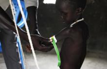 A malnourished child is weighed at the Medecins Sans Frontieres (Doctors Without Borders, MSF) feeding centre in Leer, Unity State