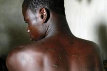 Zongo Meda, a 21-year-old cocoa farmer, shows his wounded back after being beaten by someone he said was an agent of SODEFOR, the state's forest management agency, in Guiglo, Ivory Coast, May 22, 2016. PHOTO BY REUTERS/Luc Gnago