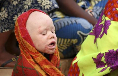An albino child sits outside the courtroom in Ruyigi, eastern Burundi in a file photo. PHOTO BY REUTERS/Jean Pierre Aime Harerimana