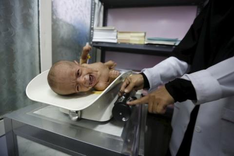 A woman holds her malnourished daughter at a malnutrition intensive care unit in Yemen's capital Sanaa, February 10, 2016. PHOTO BY REUTERS/Khaled Abdullah