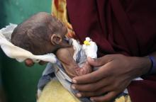 A five-month-old malnourished child awaits medical tests at the paediatric ward of the Banadir hospital in Somalia's capital Mogadishu