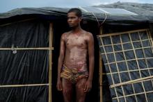 Rohingya refugee Mohamed Jabair, 21, poses for a photograph to show burns on his bodies, which he said he sustained when his house was set on fire in Myanmar, at Kutupalang refugee camp, near Cox's Bazar in Bangladesh, October 17, 2017. PHOTO BY REUTERS/Jorge Silva